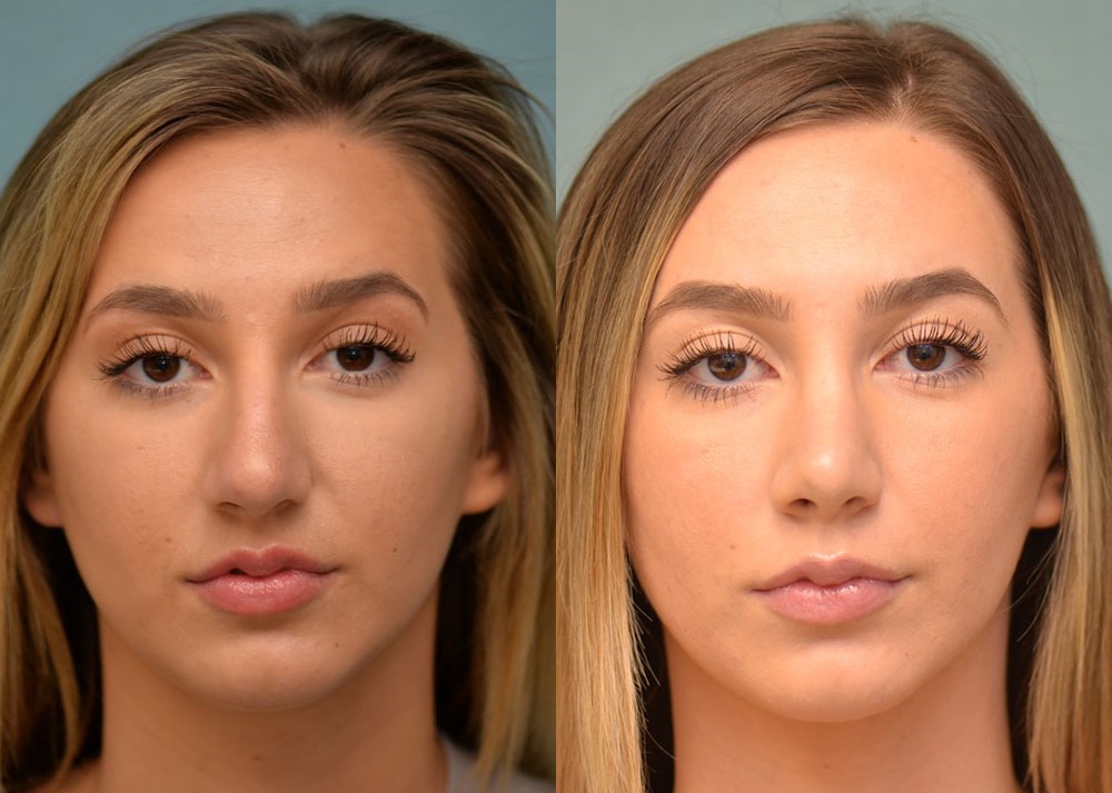 rhinoplasty before and after photo by j gerald minniti in beverly hills ca