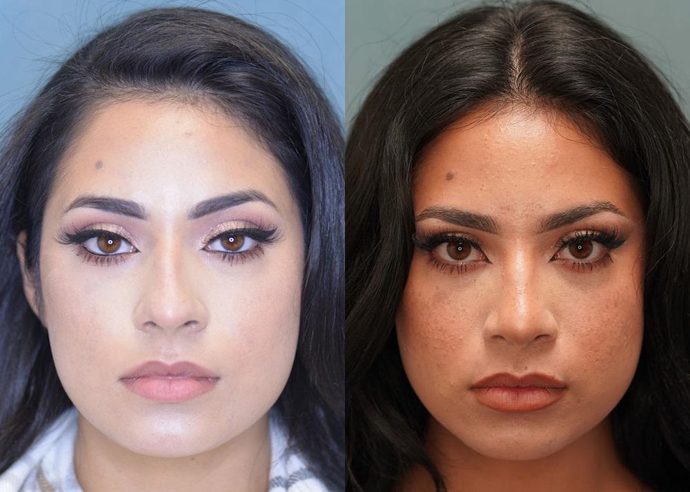 rhinoplasty before and after photo by j gerald minniti in beverly hills ca