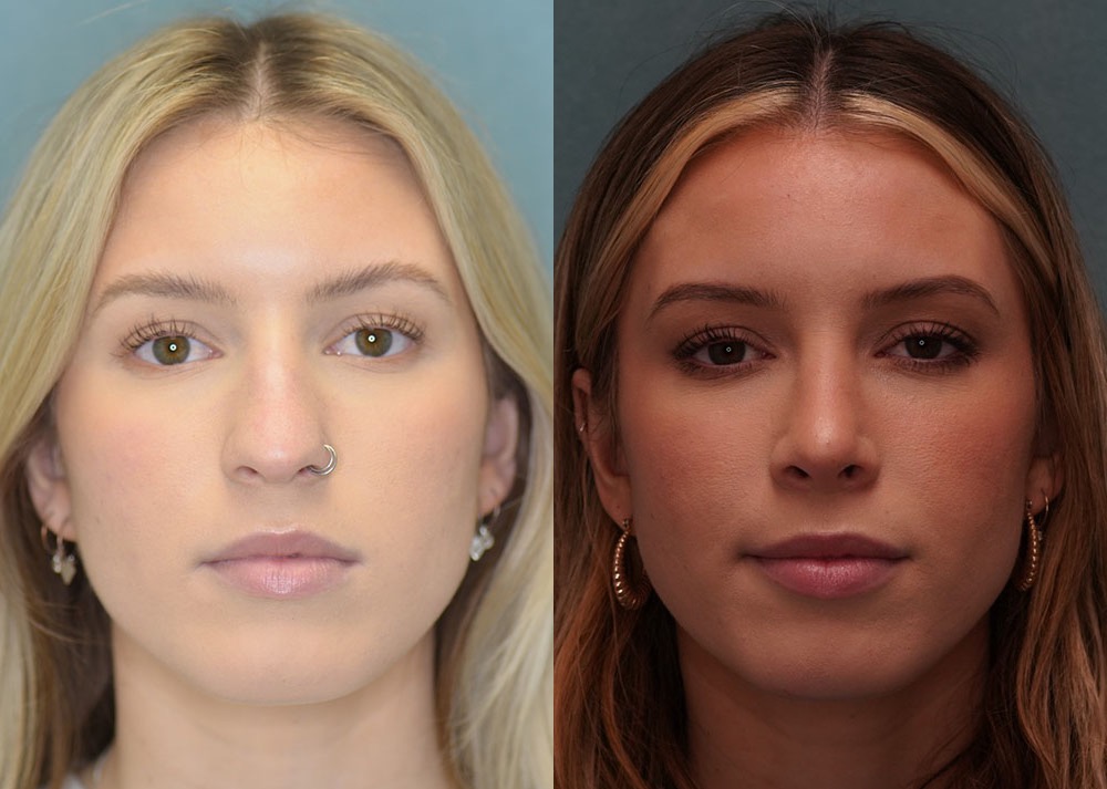rhinoplasty before and after photo by j gerald minniti in beverly hills ca