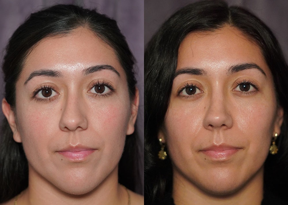 rhinoplasty before and after photo by j gerald minniti in beverly hills ca