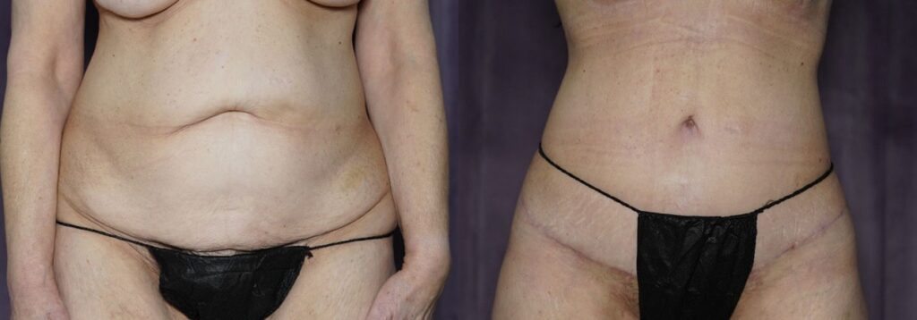 tummy tuck before and after photo by j gerald minniti in beverly hills ca
