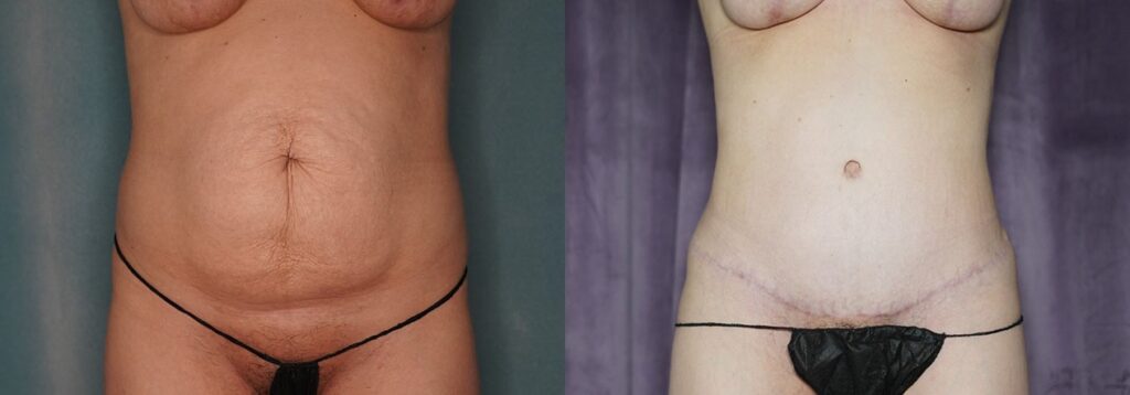 tummy tuck before and after photo by j gerald minniti in beverly hills ca
