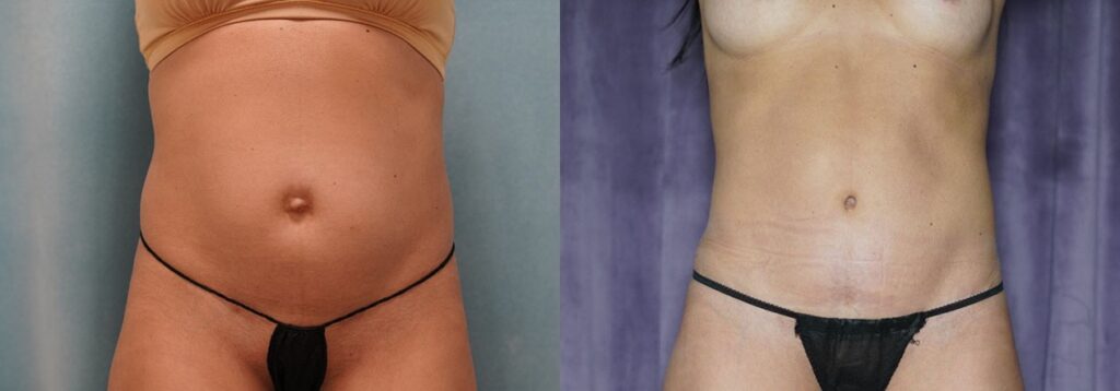 tummy tuck before and after photo by j gerald minniti in beverly hills ca
