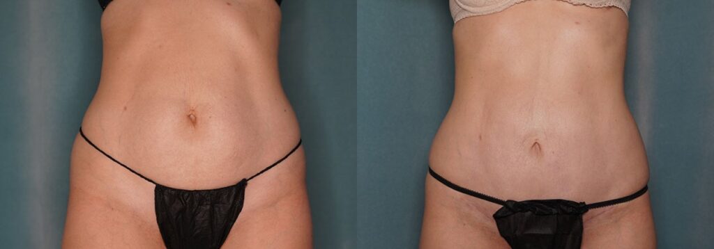 tummy tuck before and after photo by j gerald minniti in beverly hills ca