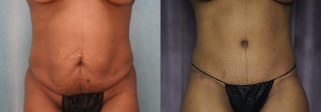 tummy tuck before and after photo by j gerald minniti in beverly hills ca