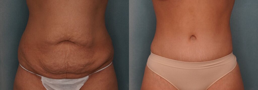 tummy tuck before and after photo by j gerald minniti in beverly hills ca