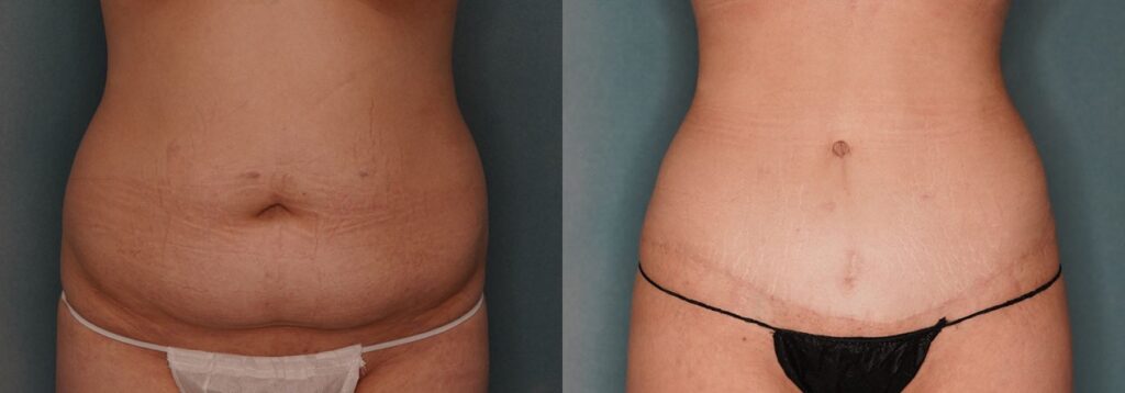 tummy tuck before and after photo by j gerald minniti in beverly hills ca