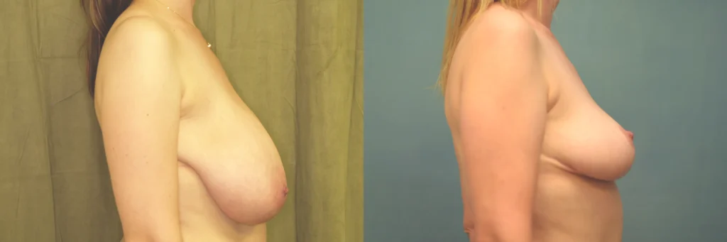 Breast reduction before and after photo by Dr Gerald Minniti