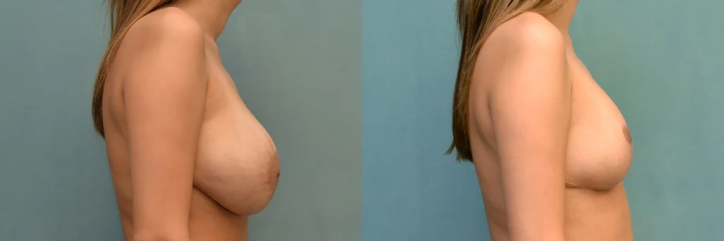 Breast reduction before and after photo by Dr Gerald Minniti