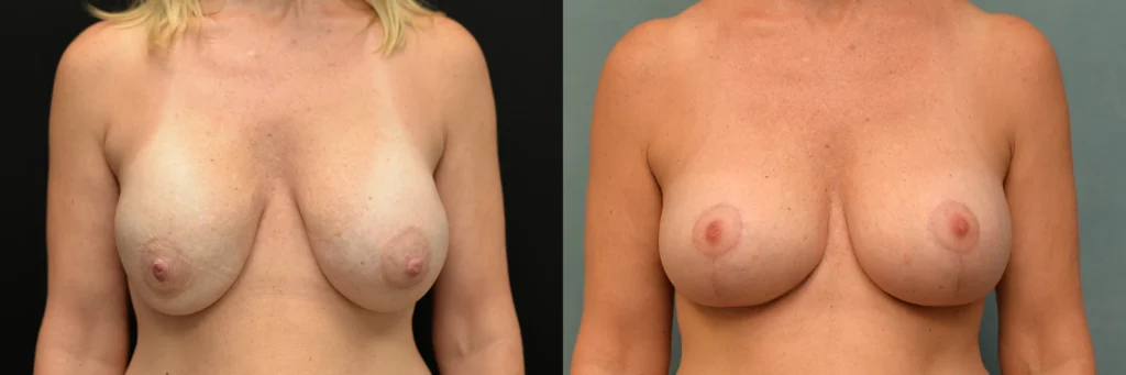 Breast revision before and after photo by Dr Gerald Minniti