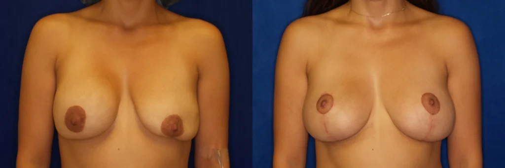 Breast revision before and after photo by Dr Gerald Minniti