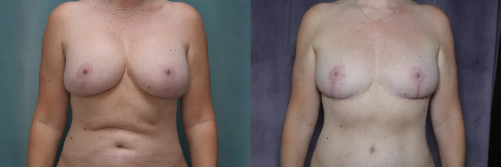 Explant revision before and after photo by Dr Gerald Minniti