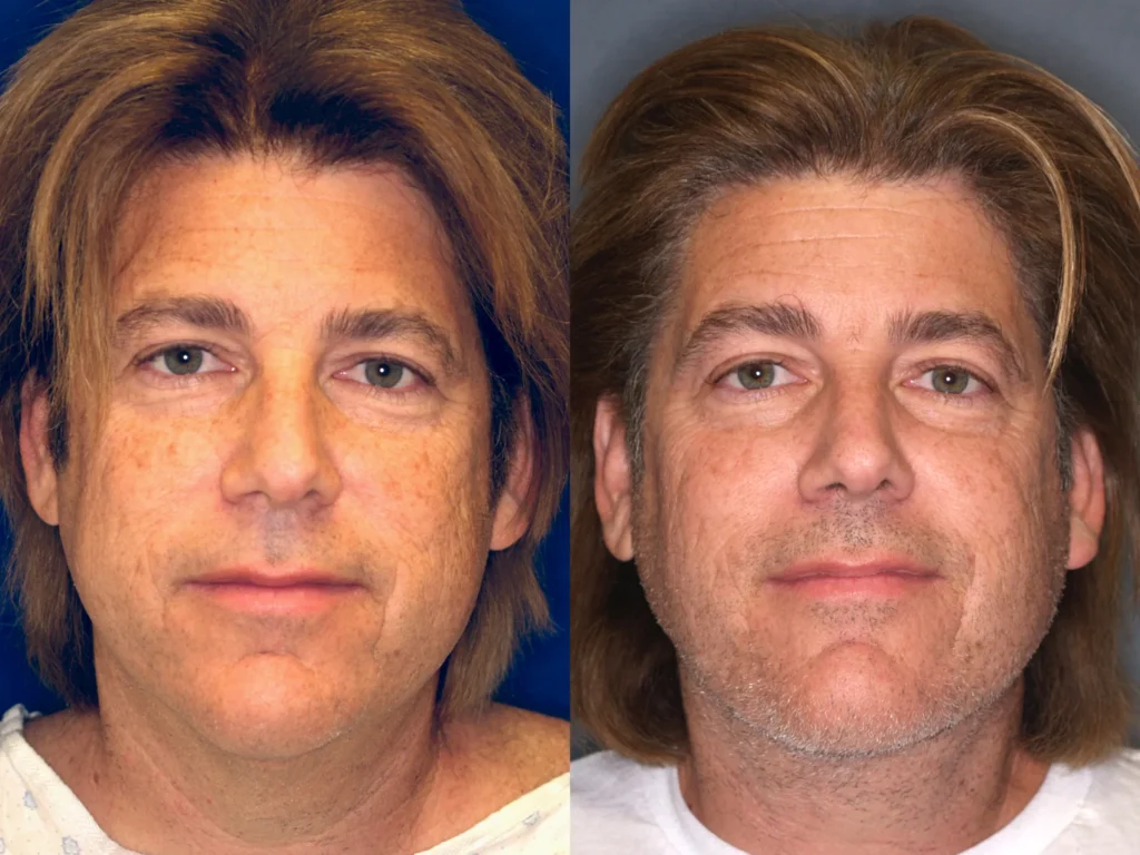 Face and Neck Lift before and after photo by Dr Gerald Minniti