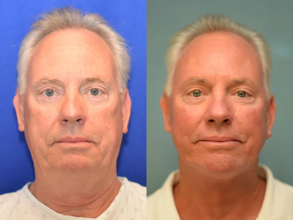 Face and Neck Lift before and after photo by Dr Gerald Minniti