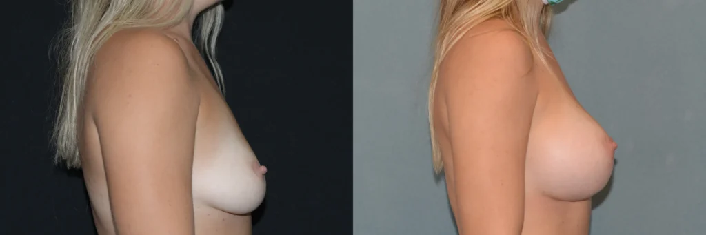 breast augmentation before and after photo by Dr Gerald Minniti