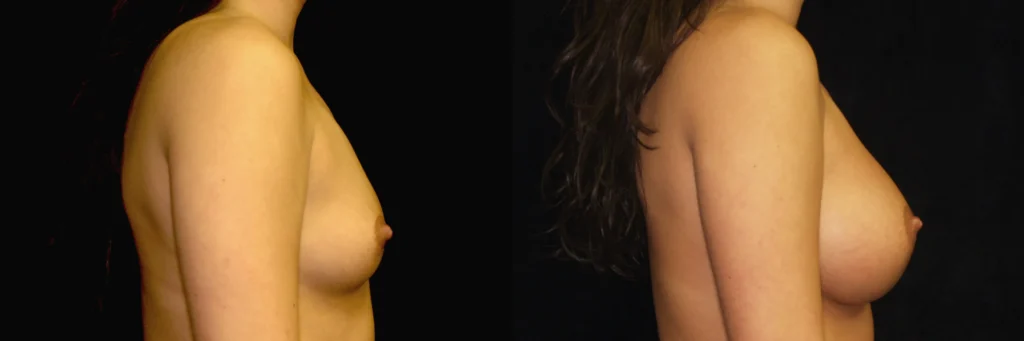 breast augmentation before and after photo by Dr Gerald Minniti
