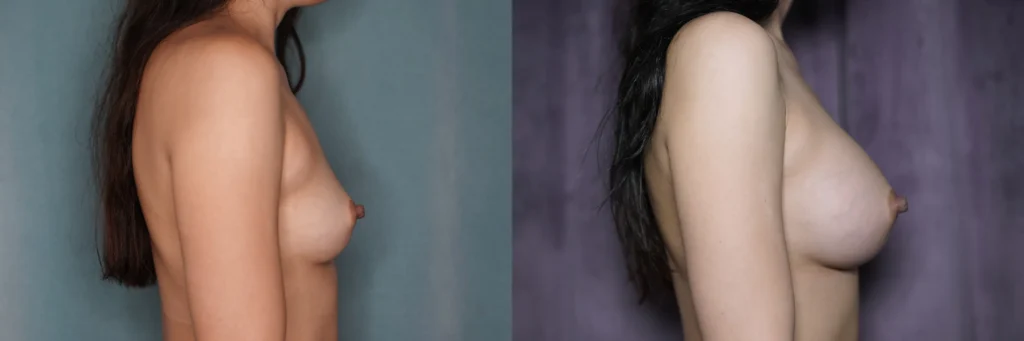 breast augmentation before and after photo by Dr Gerald Minniti