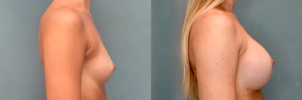 breast augmentation before and after photo by Dr Gerald Minniti