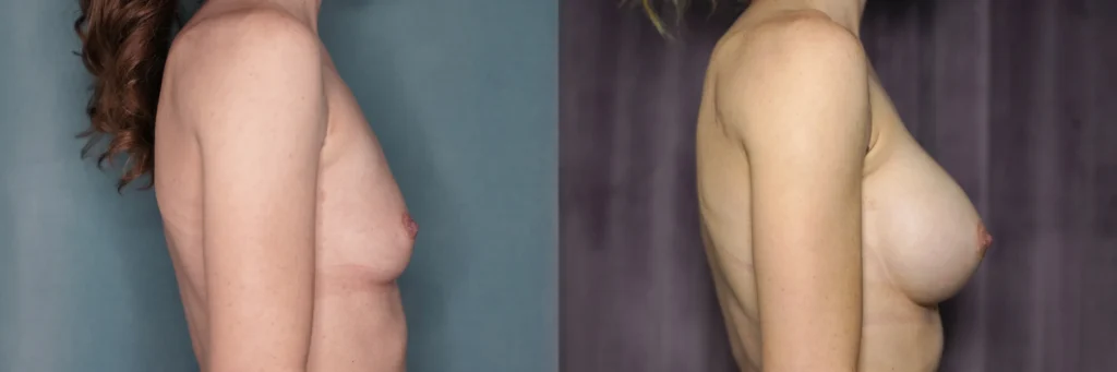 breast augmentation before and after photo by Dr Gerald Minniti