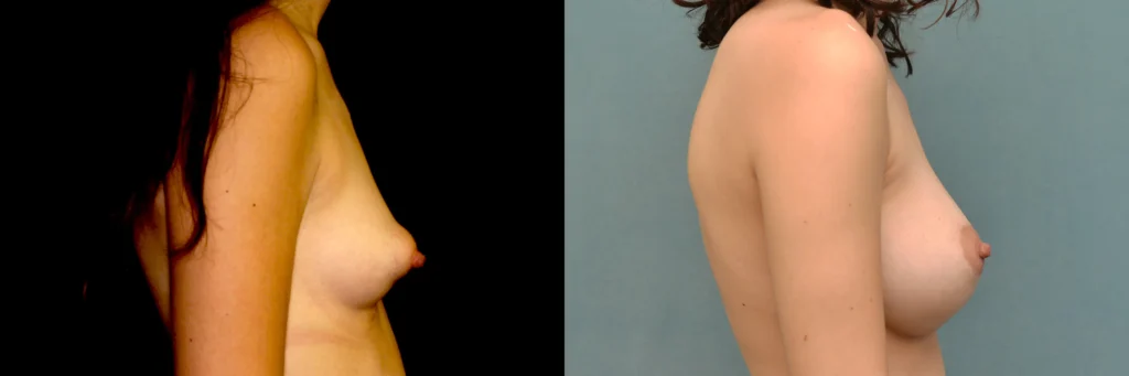 breast augmentation before and after photo by Dr Gerald Minniti