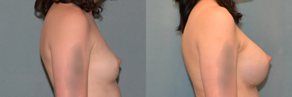 breast augmentation before and after photo by Dr Gerald Minniti