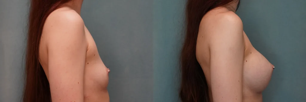 breast augmentation before and after photo by Dr Gerald Minniti