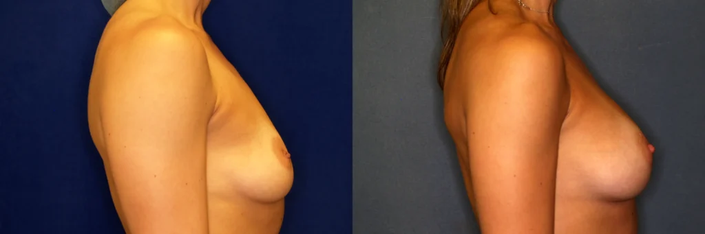breast augmentation before and after photo by Dr Gerald Minniti