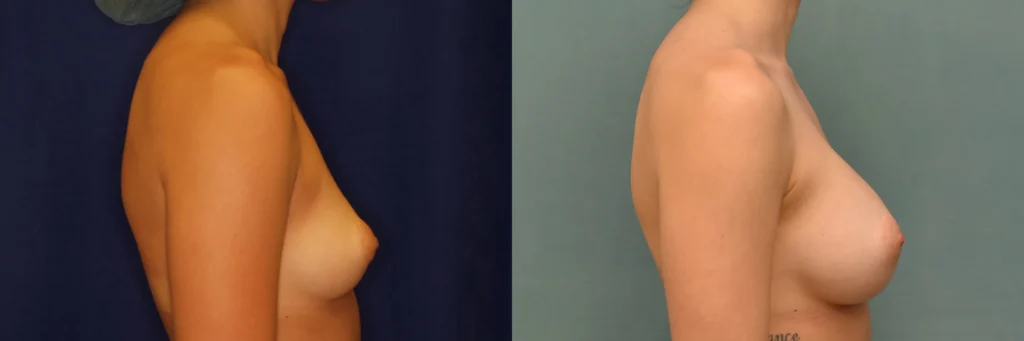 breast augmentation before and after photo by Dr Gerald Minniti