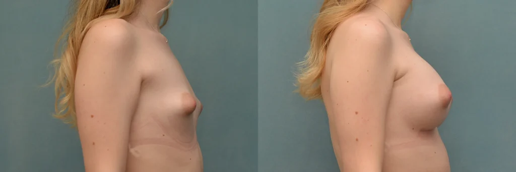 breast augmentation before and after photo by Dr Gerald Minniti