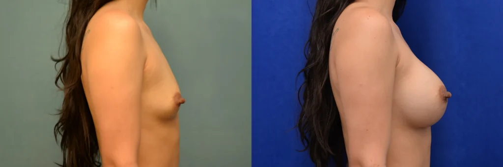 breast augmentation before and after photo by Dr Gerald Minniti