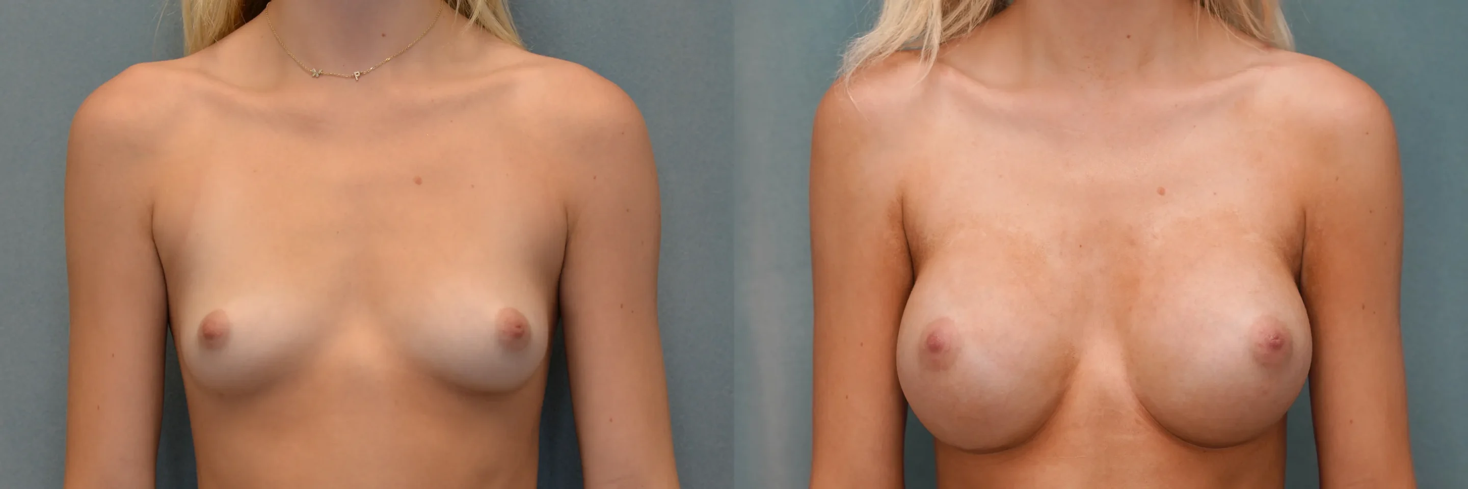 breast augmentation before and after photo by Dr Gerald Minniti