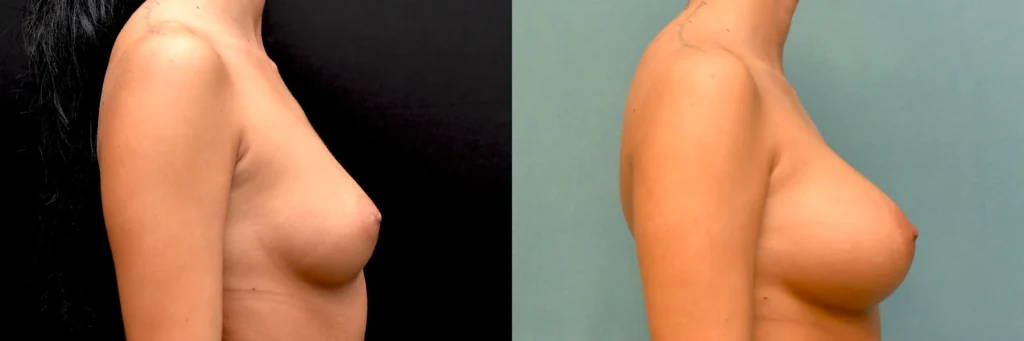 breast augmentation before and after photo by Dr Gerald Minniti