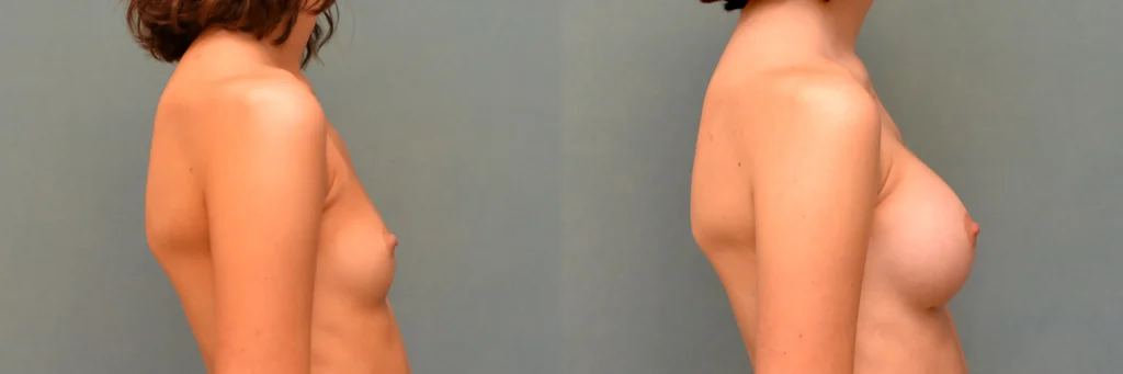 breast augmentation before and after photo by Dr Gerald Minniti