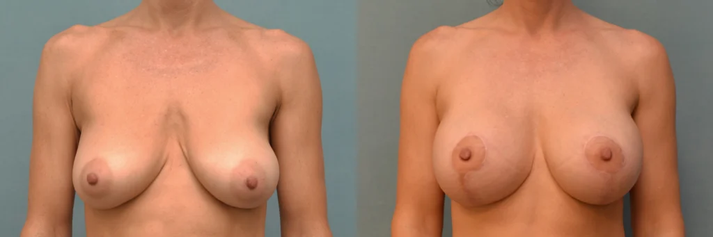 breast augmentation with lift before and after photo by Dr Gerald Minniti