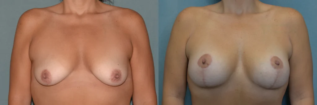 breast augmentation with lift before and after photo by Dr Gerald Minniti
