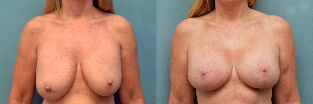 breast augmentation with lift before and after photo by Dr Gerald Minniti