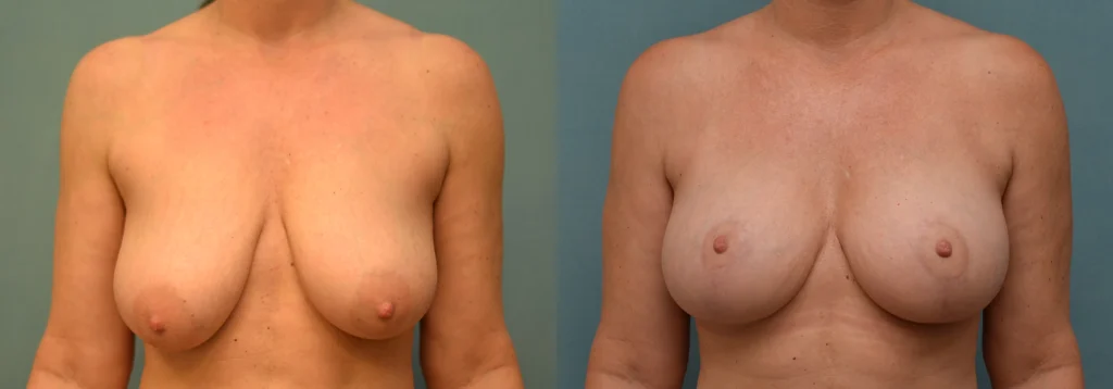 breast augmentation with lift before and after photo by Dr Gerald Minniti