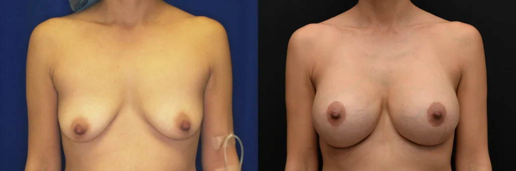 breast augmentation with lift before and after photo by Dr Gerald Minniti
