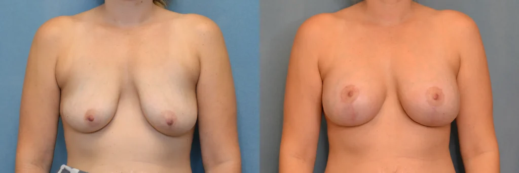 breast augmentation with lift before and after photo by Dr Gerald Minniti