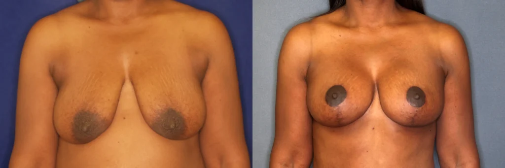 breast augmentation with lift before and after photo by Dr Gerald Minniti