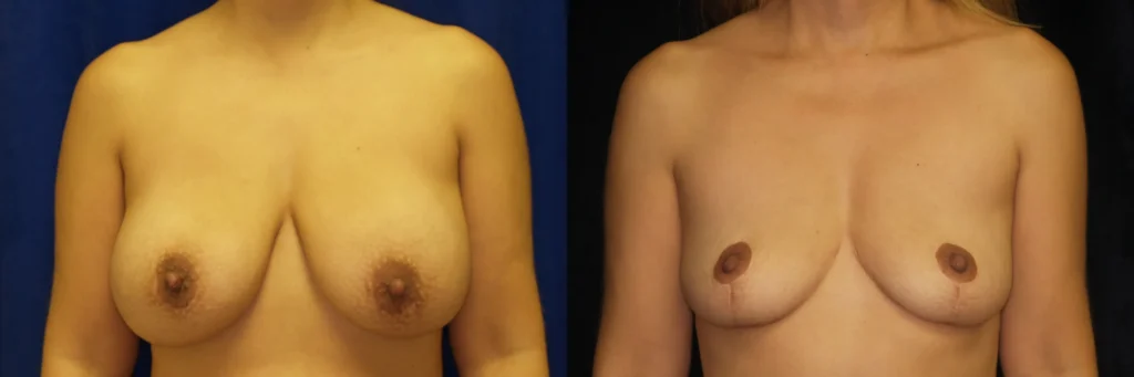 breast lift explant before and after photo by Dr Gerald Minniti