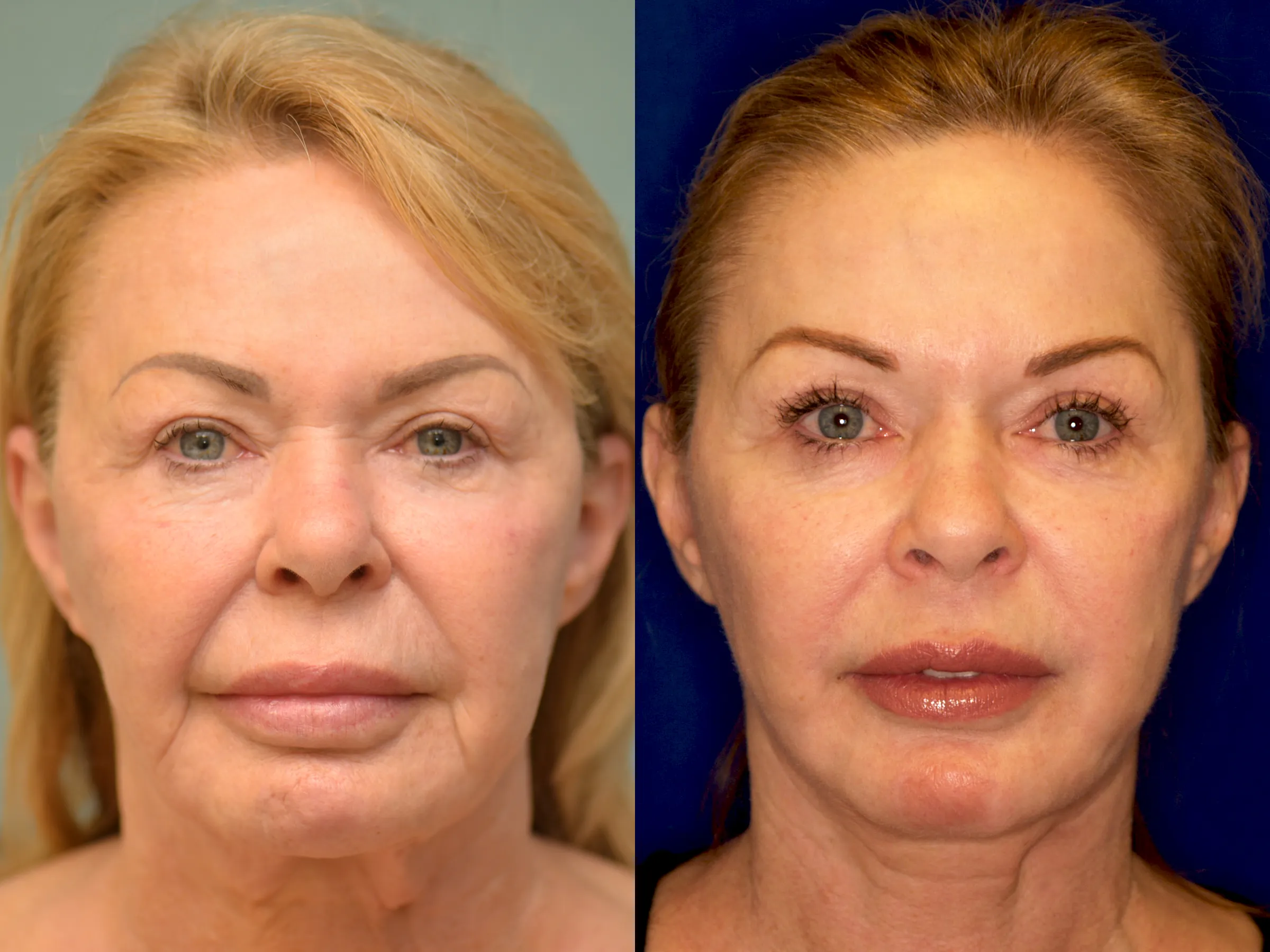 facelift before and after photo by Dr Gerald Minniti