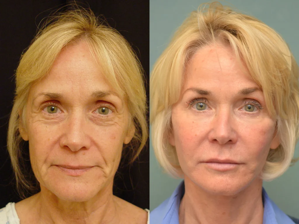 facelift browlift neck lift quad bleph before and after photo by Dr Gerald Minniti
