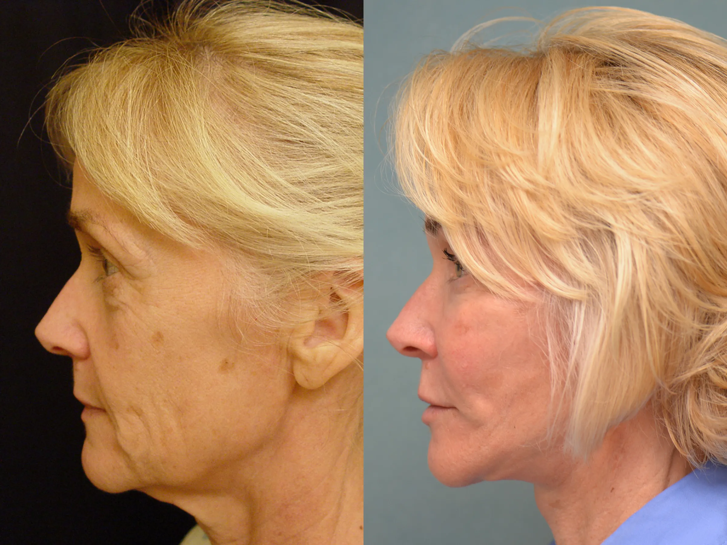 facelift browlift neck lift quad bleph before and after photo by Dr Gerald Minniti