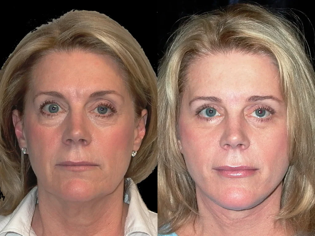 facelift necklift browlift quad bleph before and after photo by Dr Gerald Minniti