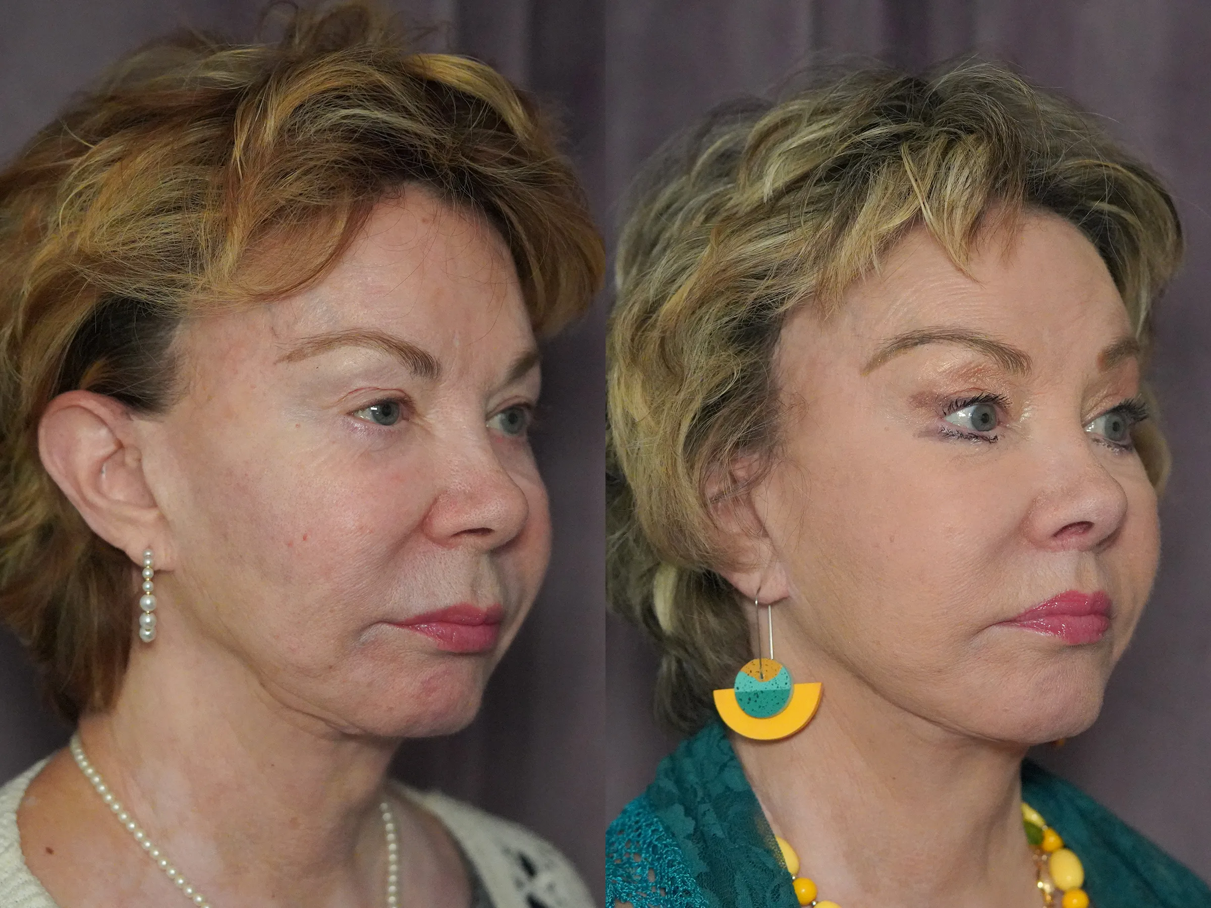 facelift revision browlift revision before and after photo by Dr Gerald Minniti