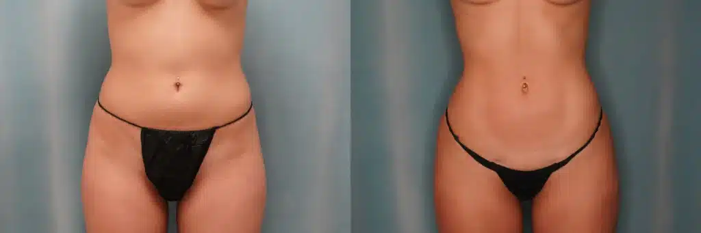 lipo bbl before and after photo by J Gerald Minniti