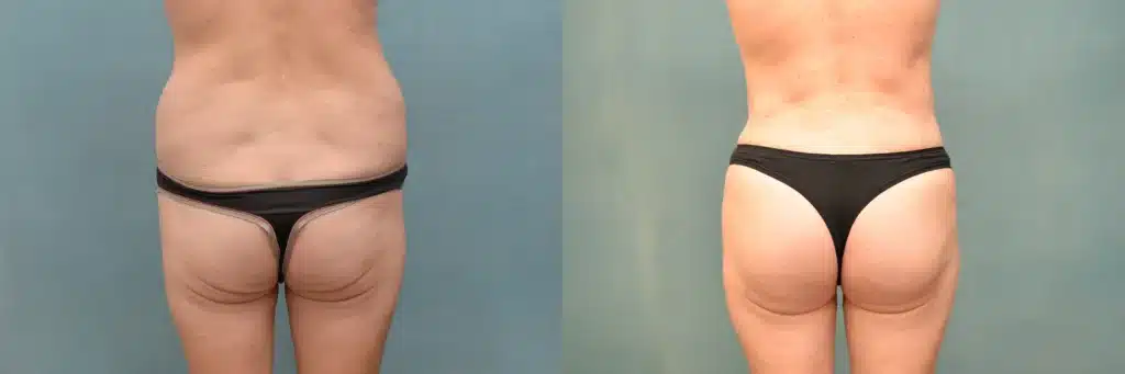 lipo bbl before and after photo by J Gerald Minniti