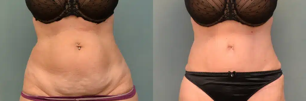 lipo bbl tummy tuck before and after photo by J Gerald Minniti
