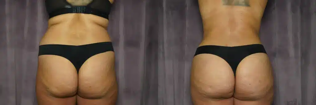 lipo bbl tummy tuck before and after photo by J Gerald Minniti